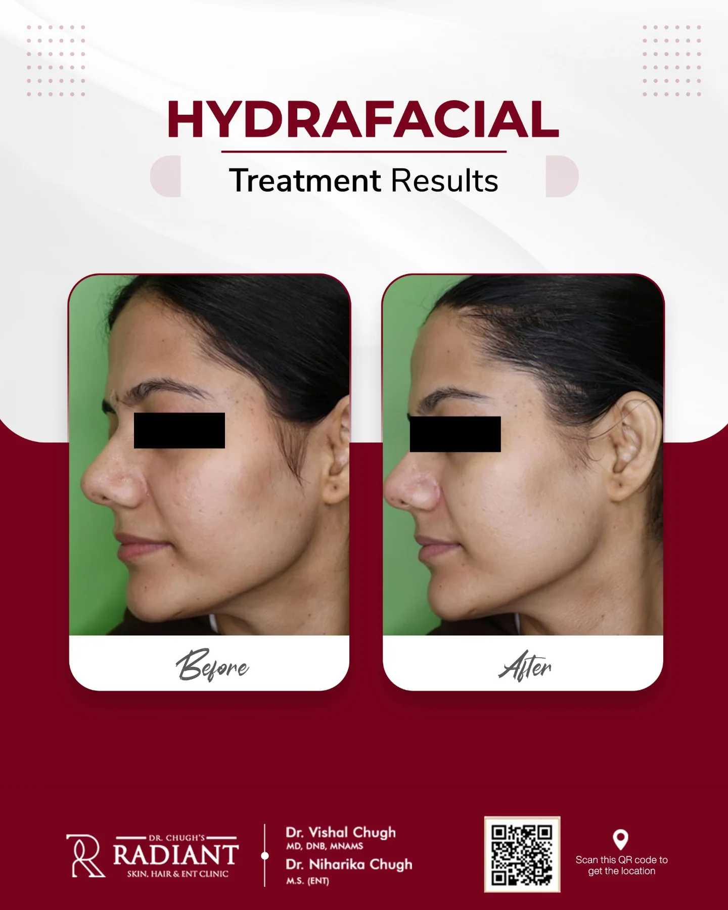 Hydrafacial Treatment in Jaipur