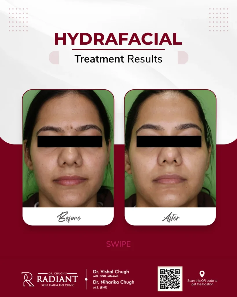 Hydrafacial Treatment in Jaipur