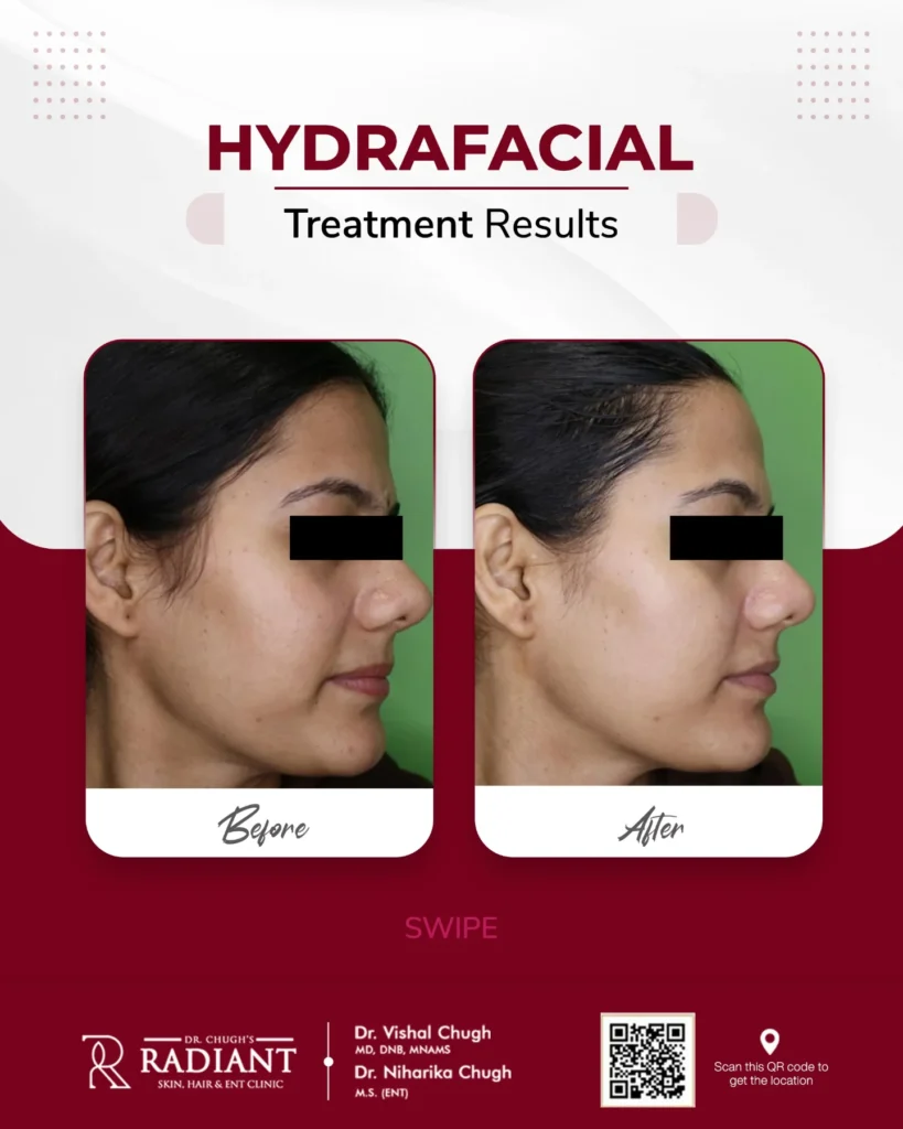 Hydrafacial Treatment in Jaipur