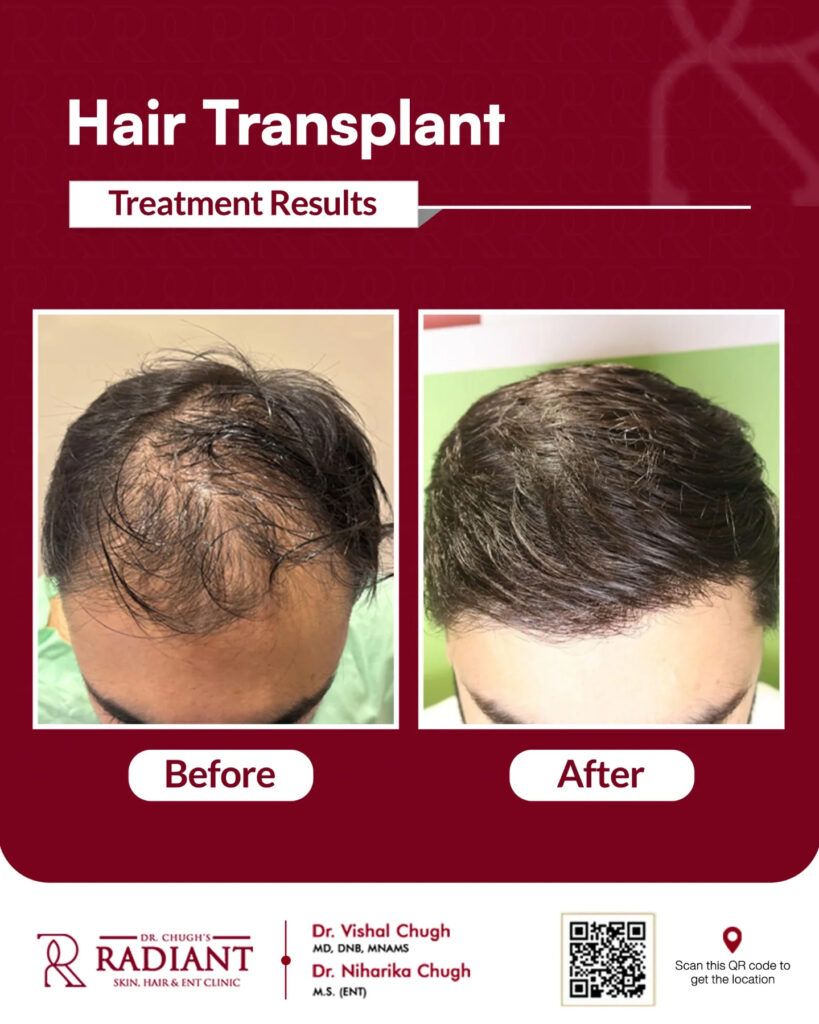 Hair Transplant Cost Jaipur