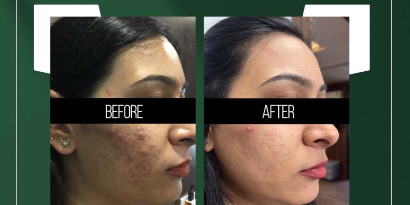 salicylic peel treatment in jaipur for acne scars